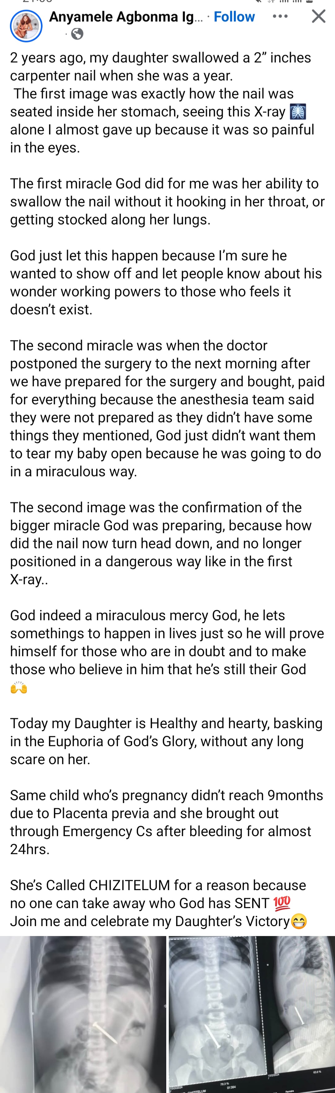Mother narrates scary experience after her daughter swallowed 2-inches carpenter nail