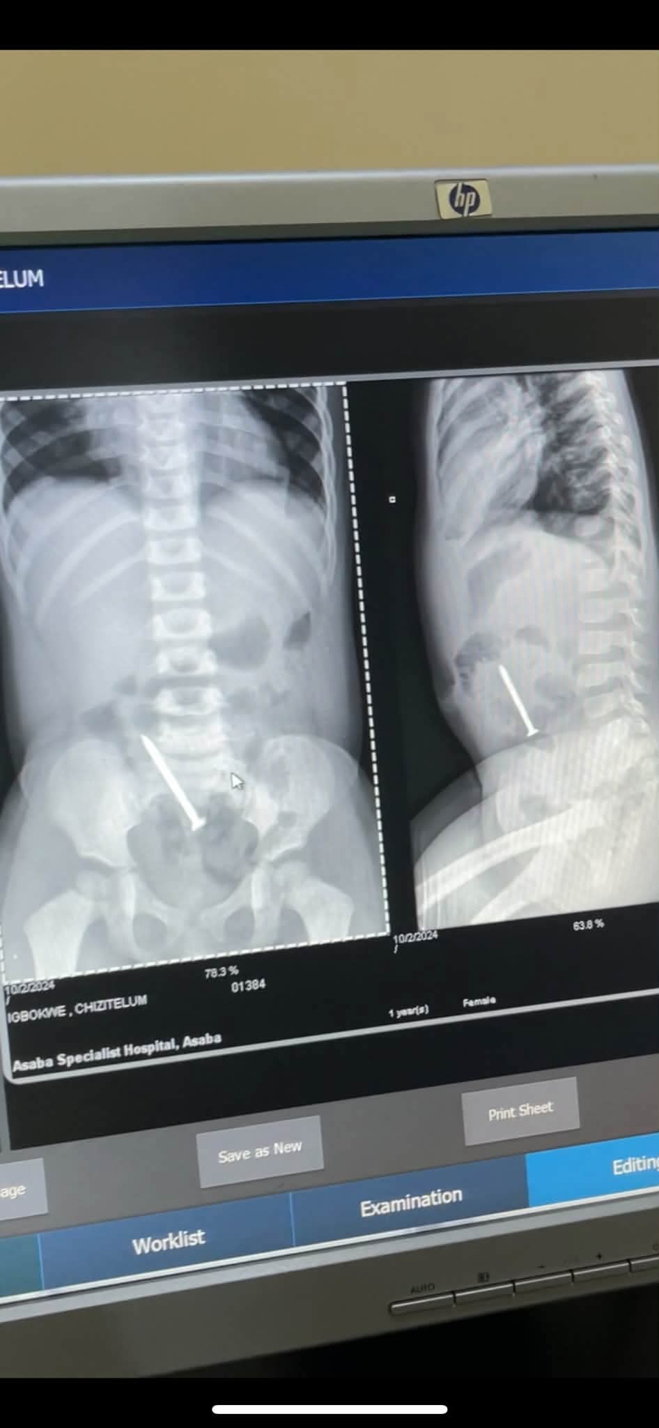 Mother narrates scary experience after her daughter swallowed 2-inches carpenter nail
