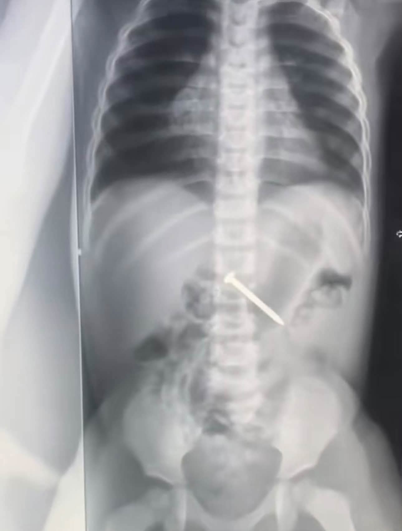 Mother narrates scary experience after her daughter swallowed 2-inches carpenter nail