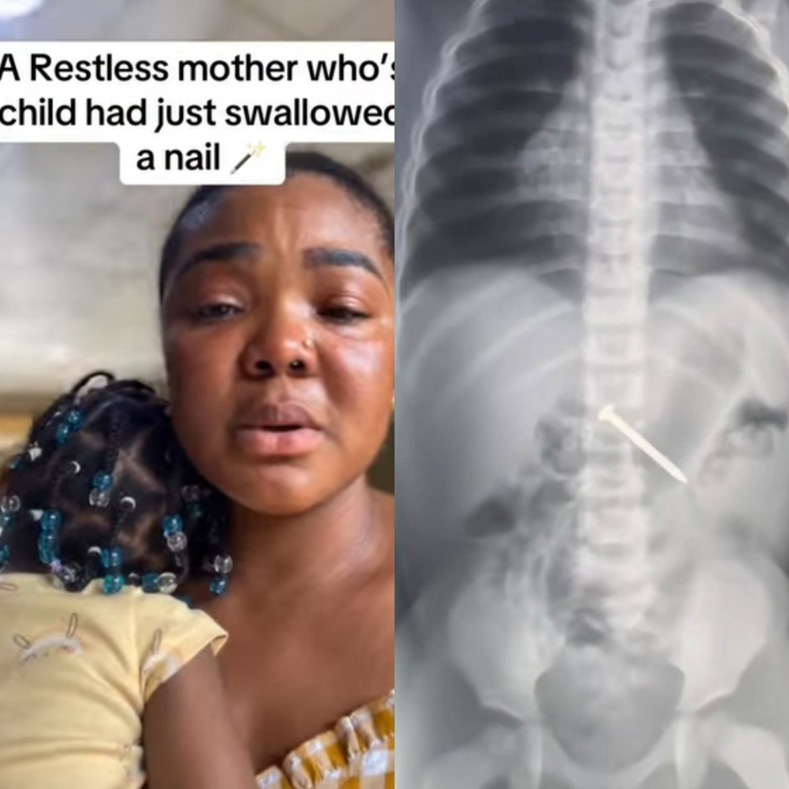 Mother narrates scary experience after her daughter swallowed 2-inches carpenter nail