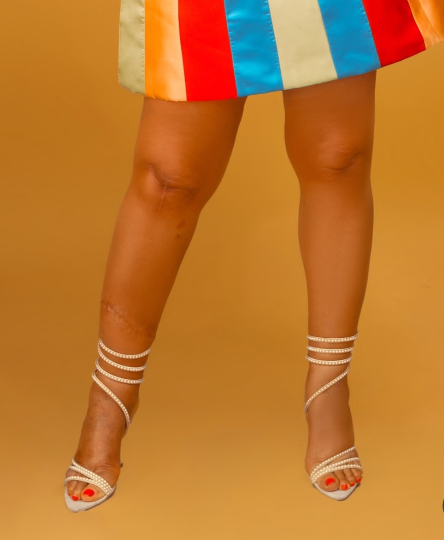 Actress Uche Nnanna shows scars as she reveals she survived terrible accident