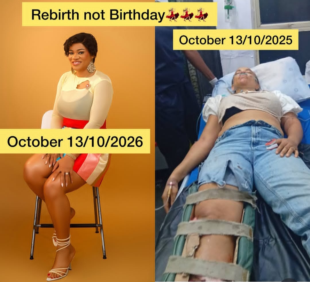 Actress Uche Nnanna shows scars as she reveals she survived terrible accident