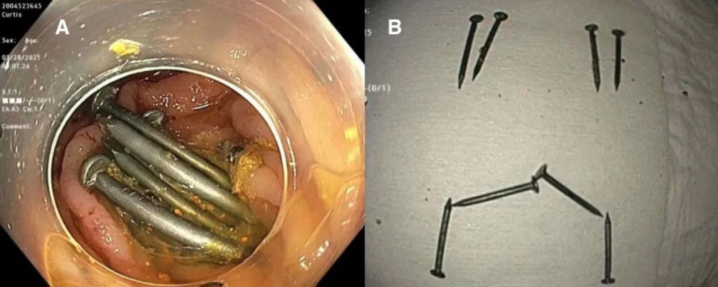 Woman, 30, undergoes surgery after eating 8 nails that blocked her intestines
