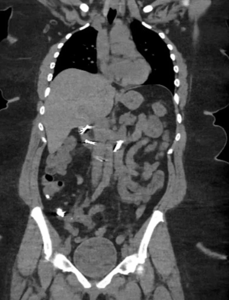 Woman, 30, undergoes surgery after eating 8 nails that blocked her intestines