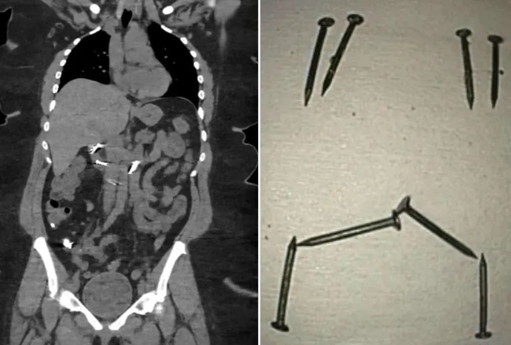 Woman, 30, undergoes surgery after eating 8 nails that blocked her intestines