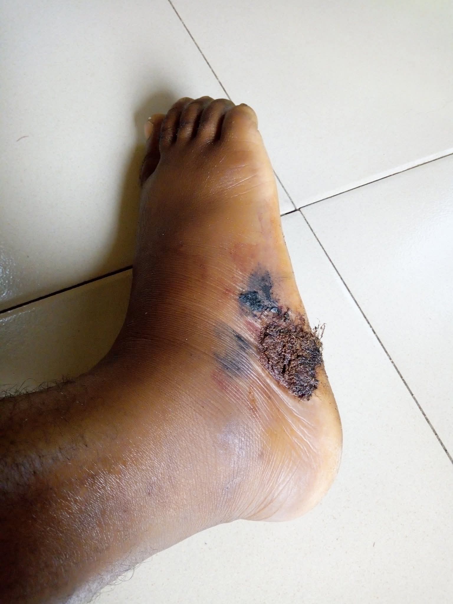 I saw shege - Nigerian lady shares her snake bite story