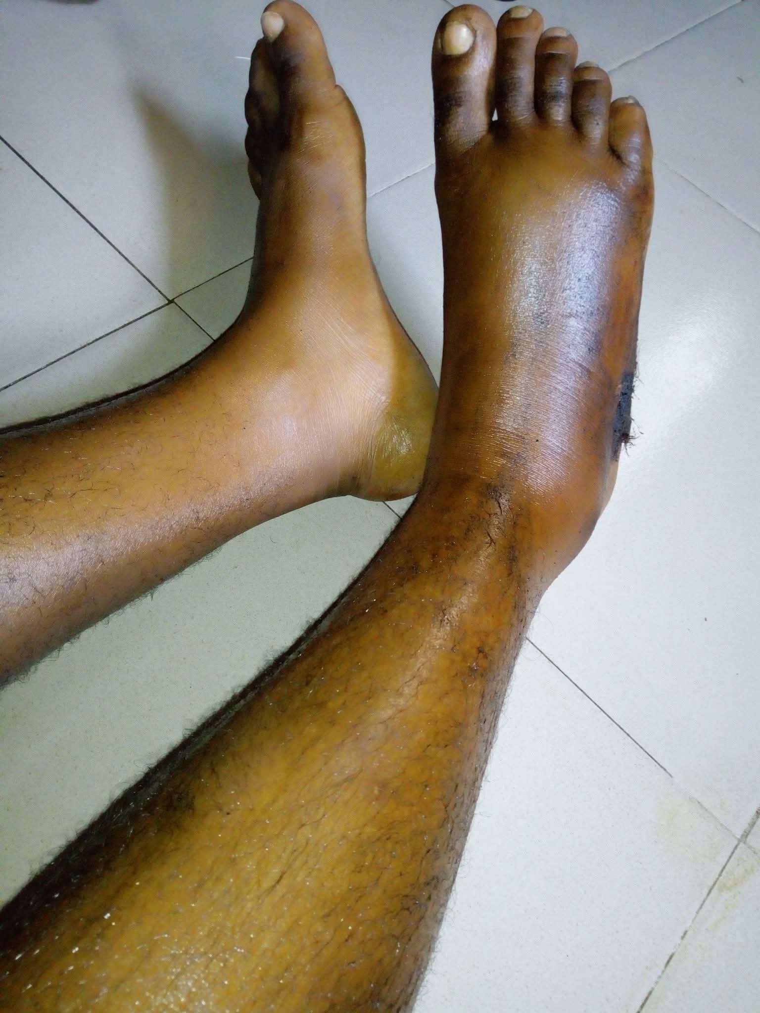 I saw shege - Nigerian lady shares her snake bite story