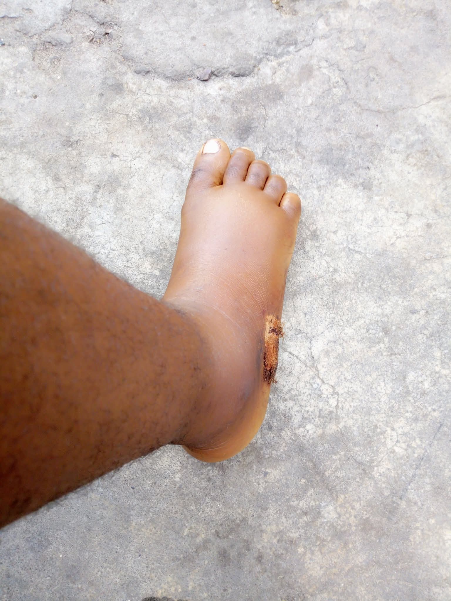 I saw shege - Nigerian lady shares her snake bite story