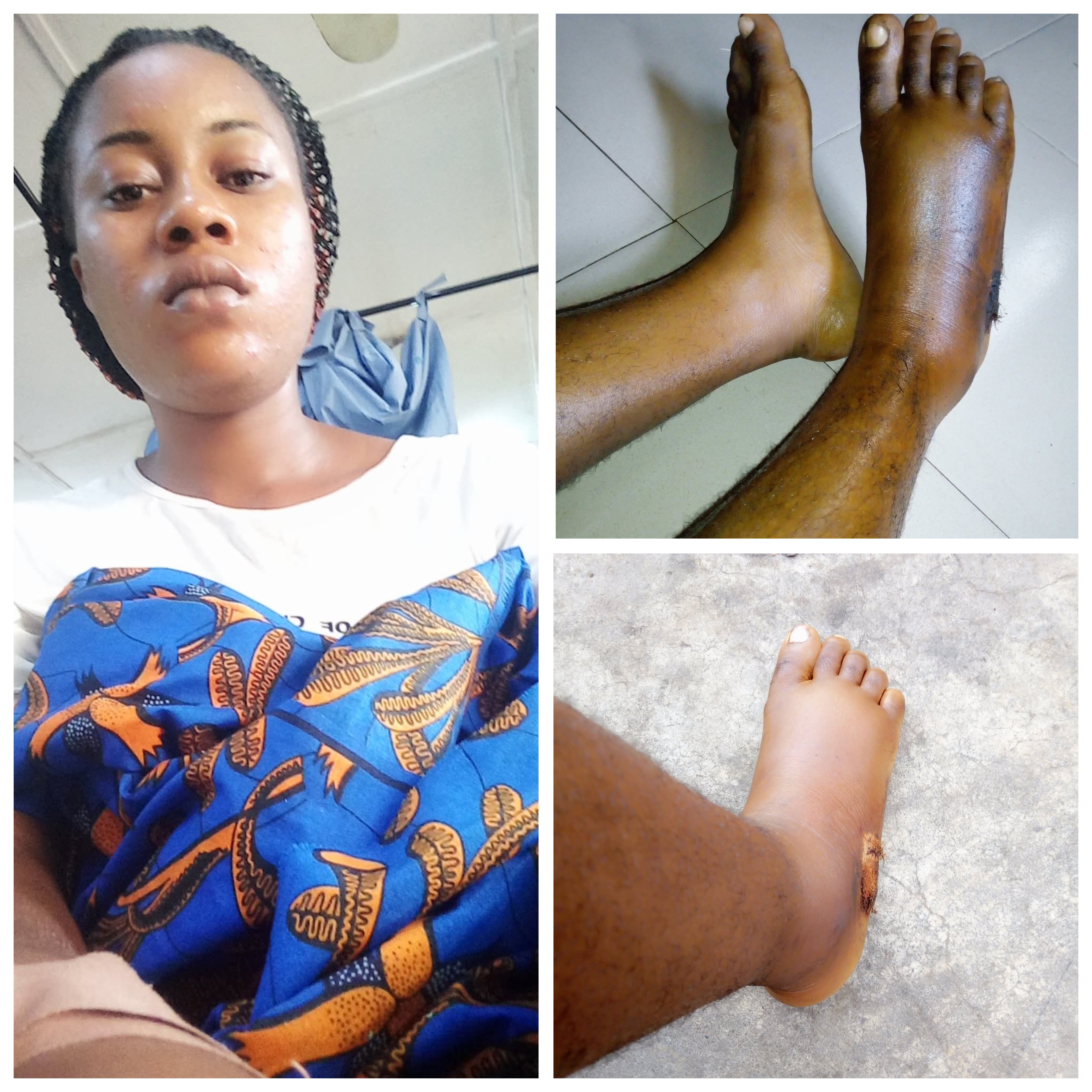 I saw shege - Nigerian lady shares her snake bite story
