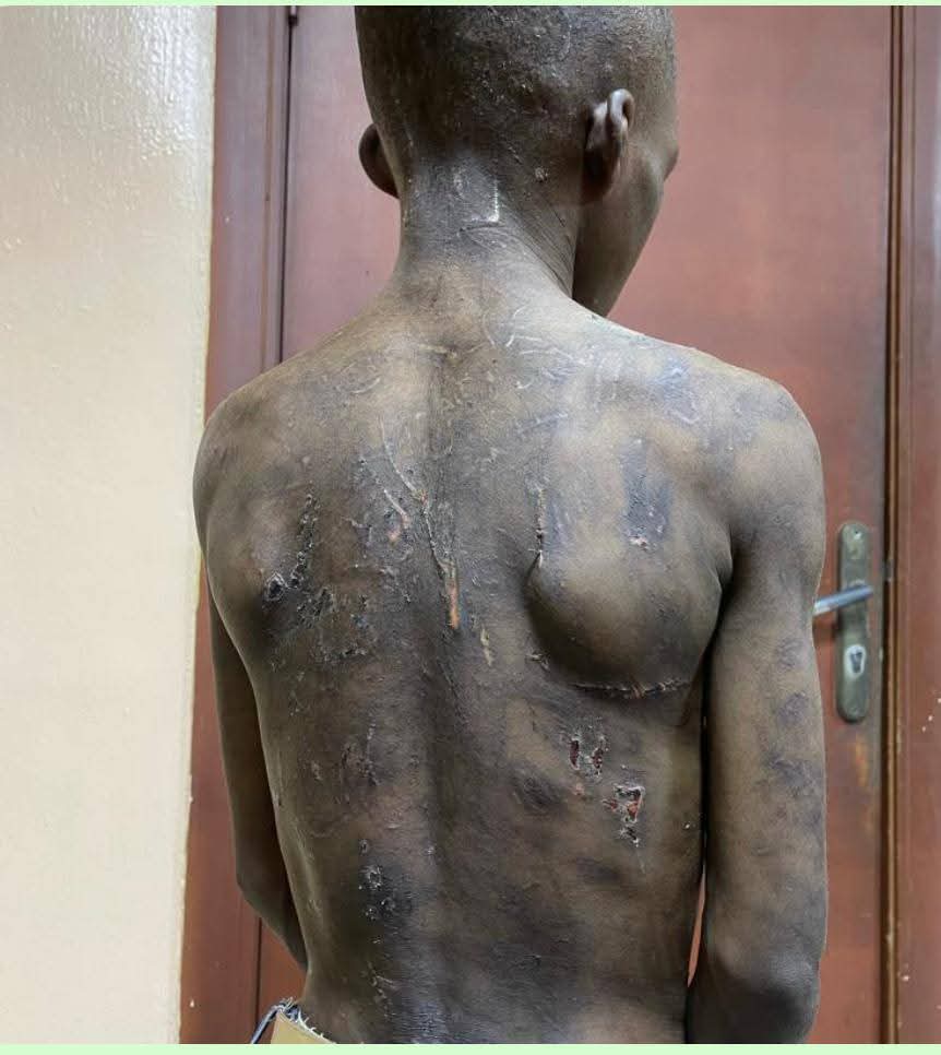 Lagos State Govt rescues 11-year-old boy tortured by his biological mother