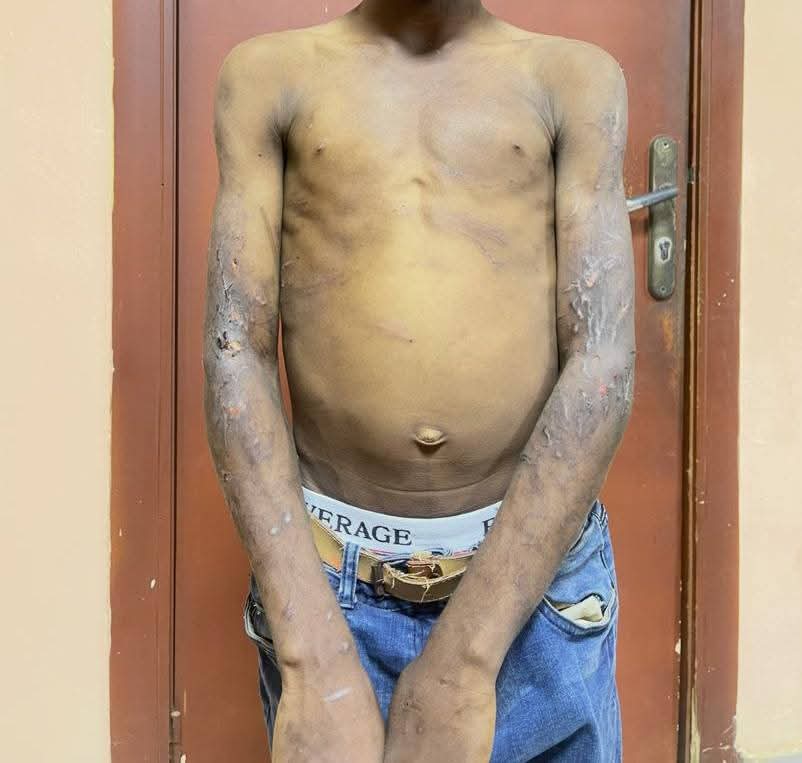 Lagos State Govt rescues 11-year-old boy tortured by his biological mother
