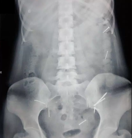 Doctors discover 9 nails in Indian woman’s stomach and they remove it without surgery