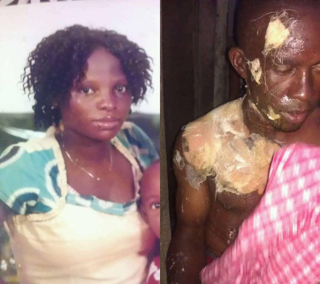 Photos: Angry woman scalds her husband with hot water in Lagos
