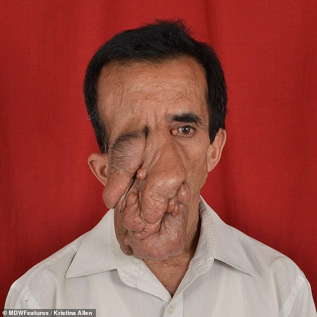 Nepalese man with tumors covering half of his face finally has it removed after cruel strangers branded him a 'devil' (Photos)