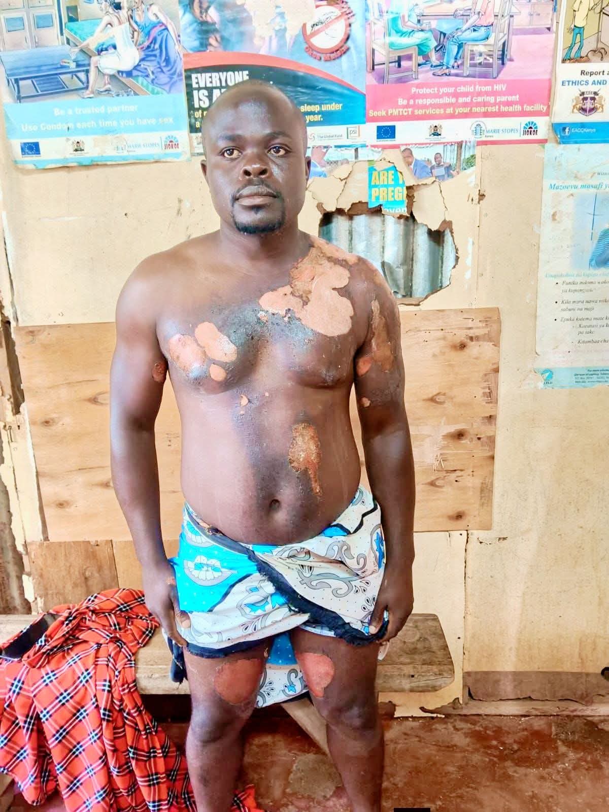 Kenyan woman attacks her husband with boiling water after he introduced his second wife