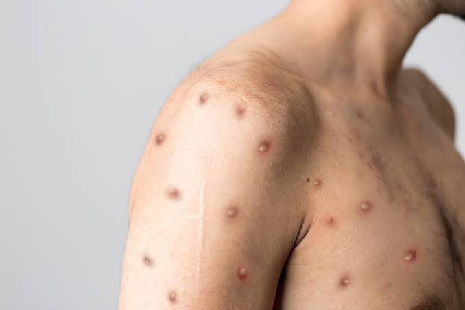 "Classifying the virus as an STI more accurately reflects transmission of the new strain' - Scientists call for monkeypox to be reclassified as an STI