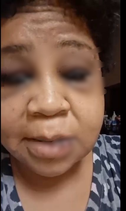 Leave - Woman advises those in abusive relationship as she shares video showing her face with bruises