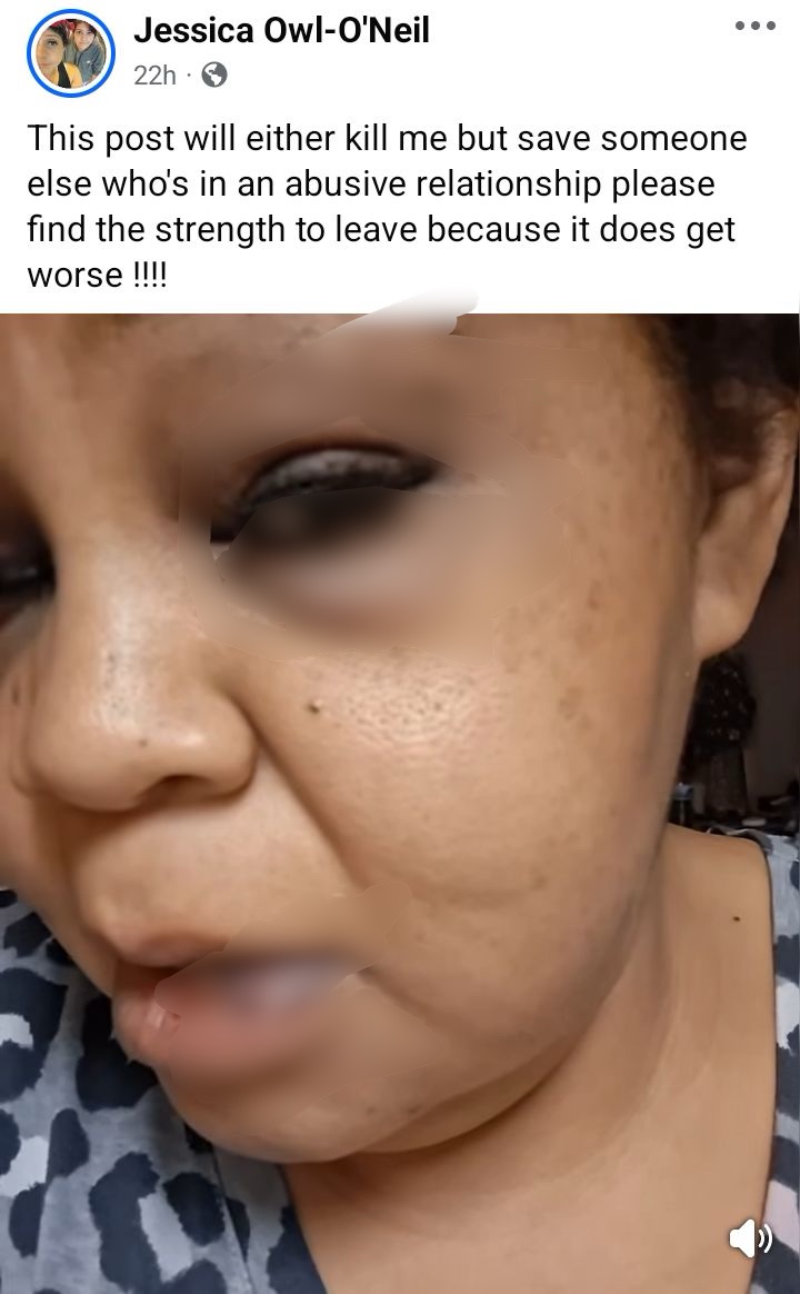 Leave - Woman advises those in abusive relationship as she shares video showing her face with bruises