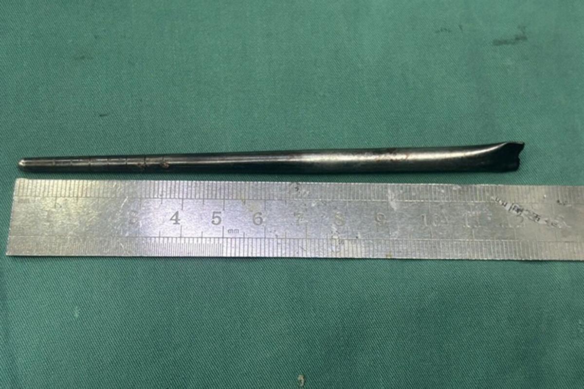 Drunkard spent 8 years with metal chopstick stuck in his throat