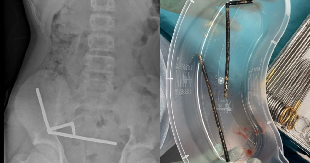 13-year-old boy hospitalized and loses part of bowel after swallowing dozens of high-powered magnets