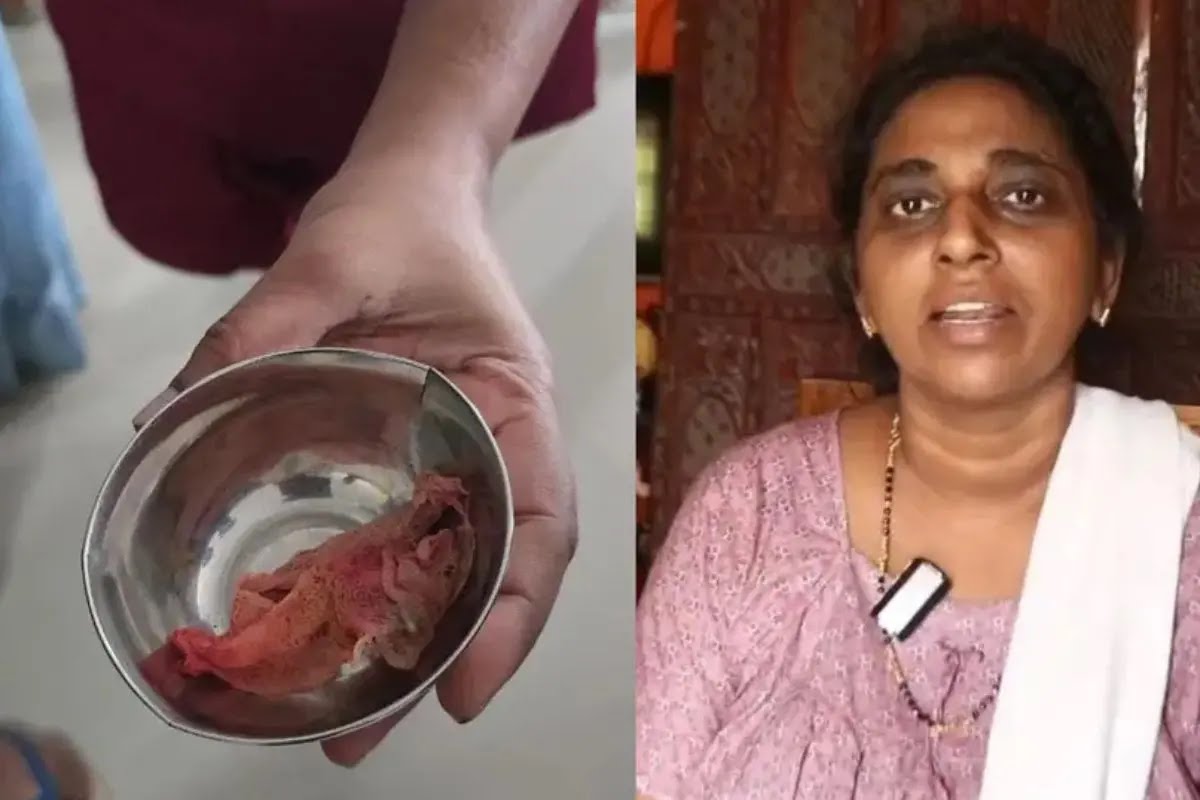 Surgeon's cloth found inside woman's abdomen three months after surgery